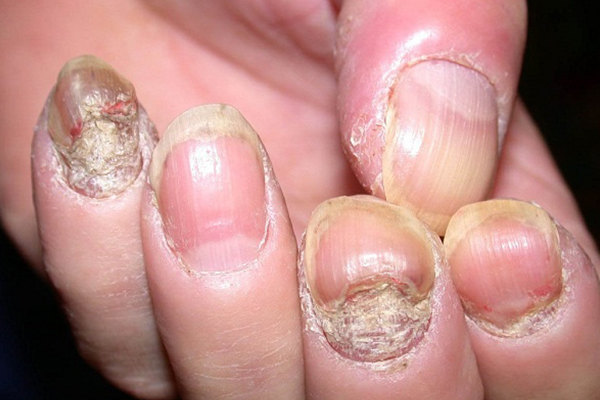 Biểu hiện của bệnh nâm móng tay